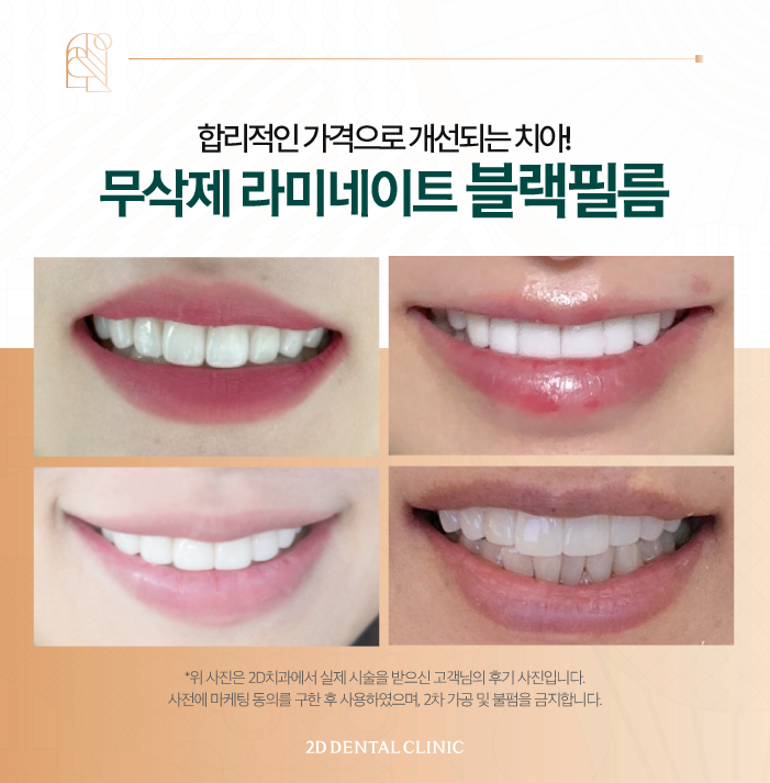 치아 삭제 없는 블랙필름 무삭제라미네이트후기 관련 이미지 8