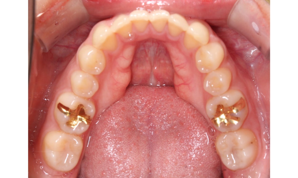 나비앞니 세라믹교정 case 관련 이미지 7