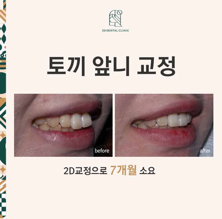 강남역 치과에서 앞니부분 설측 2D(투디)교정으로 토끼앞니 탈출한 후기 관련 이미지 1
