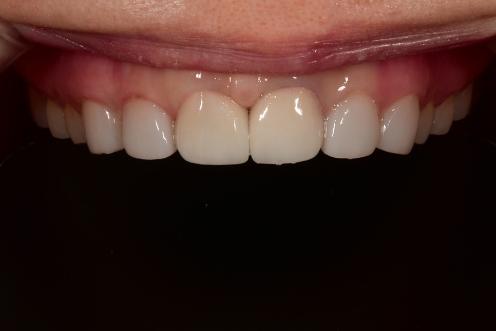 [투디치과] 블랙필름(비스포크) 치료의 다양한 사례 관련 이미지 15