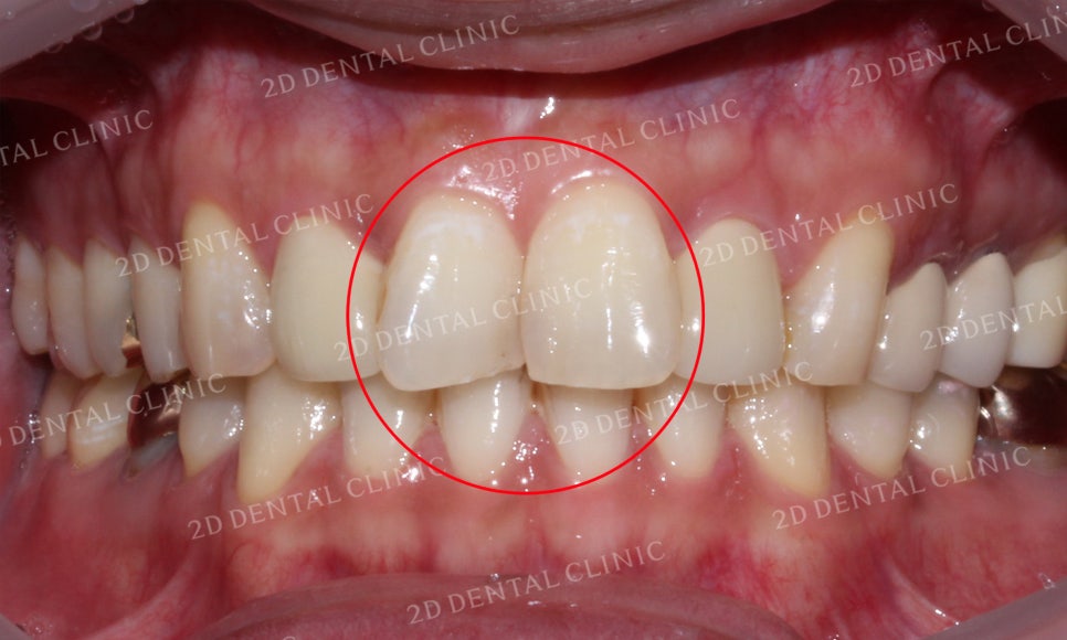 [2D교정] 나비치아교정을 2D교정 장치로 빠르게 완성하기! by.2D치과(투디치과) 관련 이미지 5