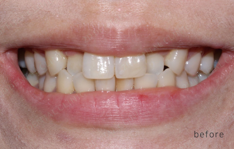 2D치과(투디치과) 교정일기ㅣ앞니덧니,반대교합 치아교정 완료!(ft.투디교정 전체교정) 관련 이미지 13