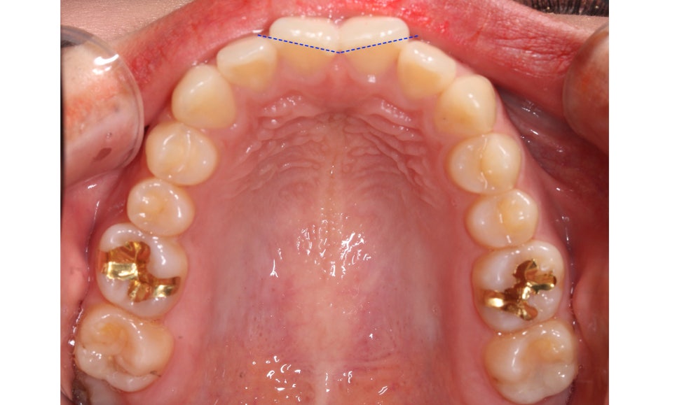 나비앞니 세라믹교정 case 관련 이미지 6