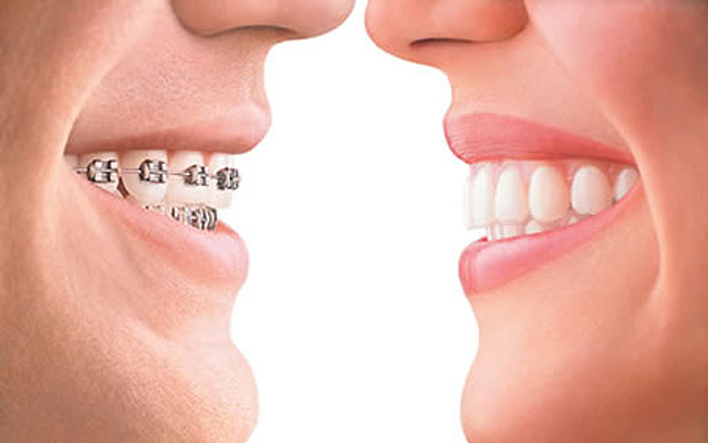 치아 교정 만큼 중요한 사후관리, 유지 장치 관련 이미지 10