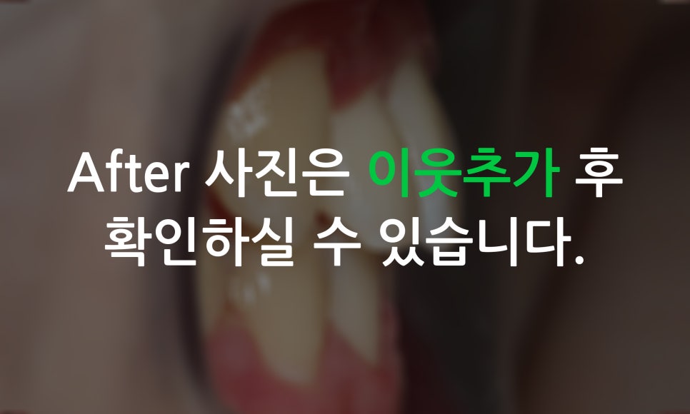 송곳니덧니가 있을 때 교정하는 방법! 관련 이미지 6