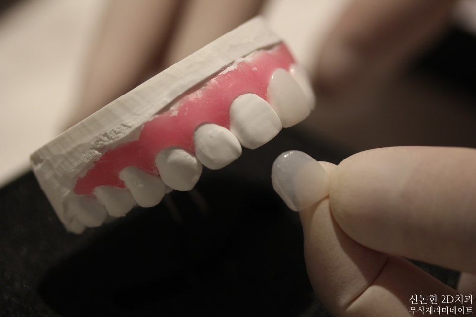 강남라미네이트치과 추천 : 진짜 무삭제, 투디치과! 관련 이미지 1