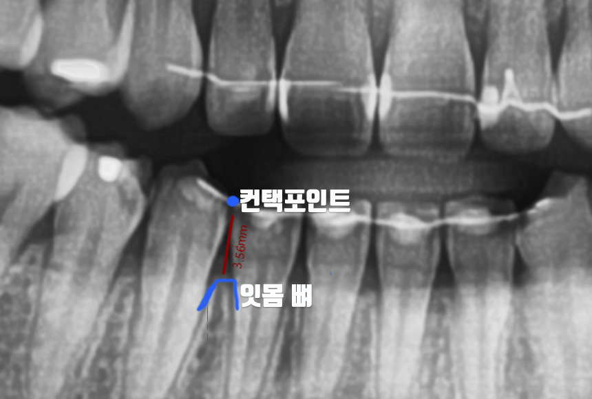 치아 블랙트라이앵글 원인, 예방, 치료 무삭제라미네이트 관련 이미지 4