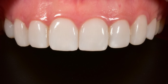 무삭제라미네이트잘하는곳 치아성형 2D치과 블랙필름 관련 이미지 4