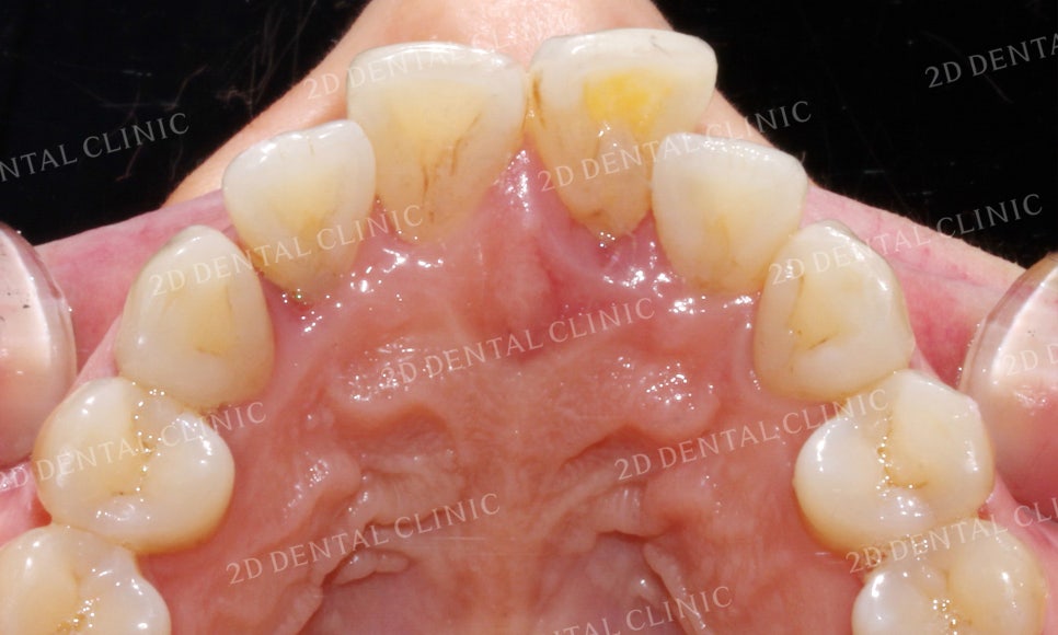 [앞니교정] 돌출앞니교정, 토끼앞니를 클리피씨교정으로 완성하기! by. 투디치과(2D치과) 관련 이미지 11