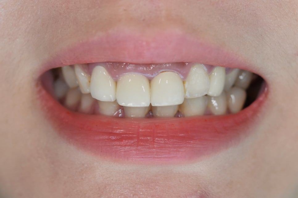 연예인라미네이트 무삭제로 잘하는 2D치과 관련 이미지 11