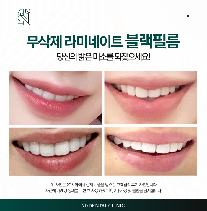 강남라미네이트 투디치과 블랙필름에 없는 3가지는? 관련 이미지 7