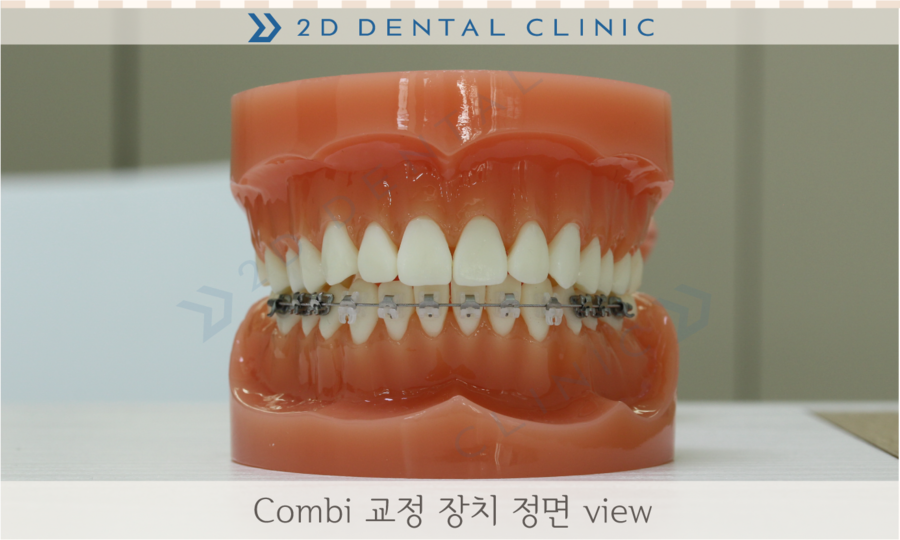 [교정상식] 설측교정,투명교정,콤비교정 장치종류 및 장단점! 관련 이미지 6