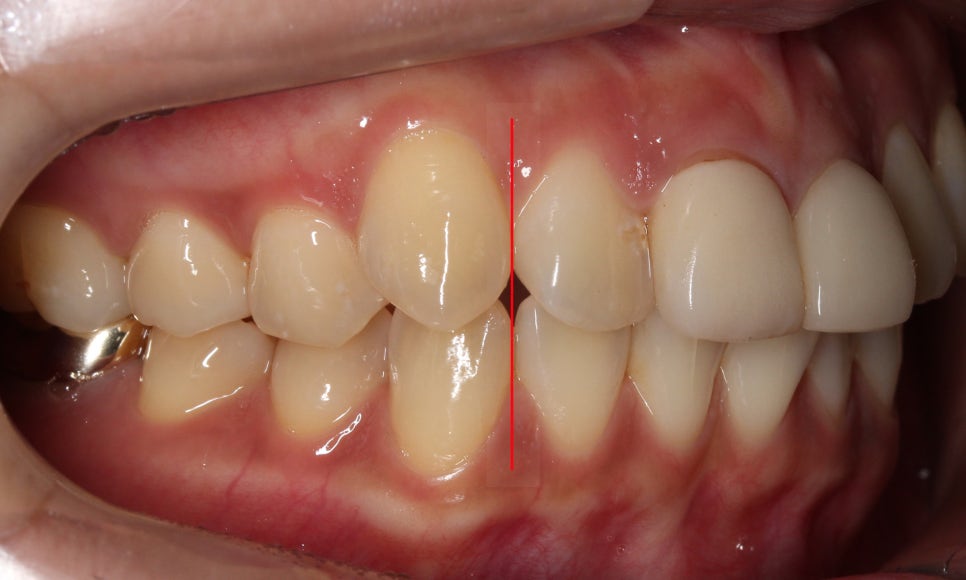 토끼앞니교정, PFM크라운 재보철을 동시에 치료하는 방법? 관련 이미지 4
