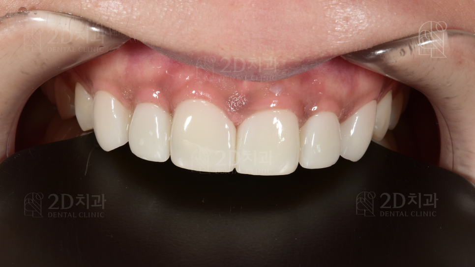 왜소치 라미네이트  신논현역 2D치과 관련 이미지 8