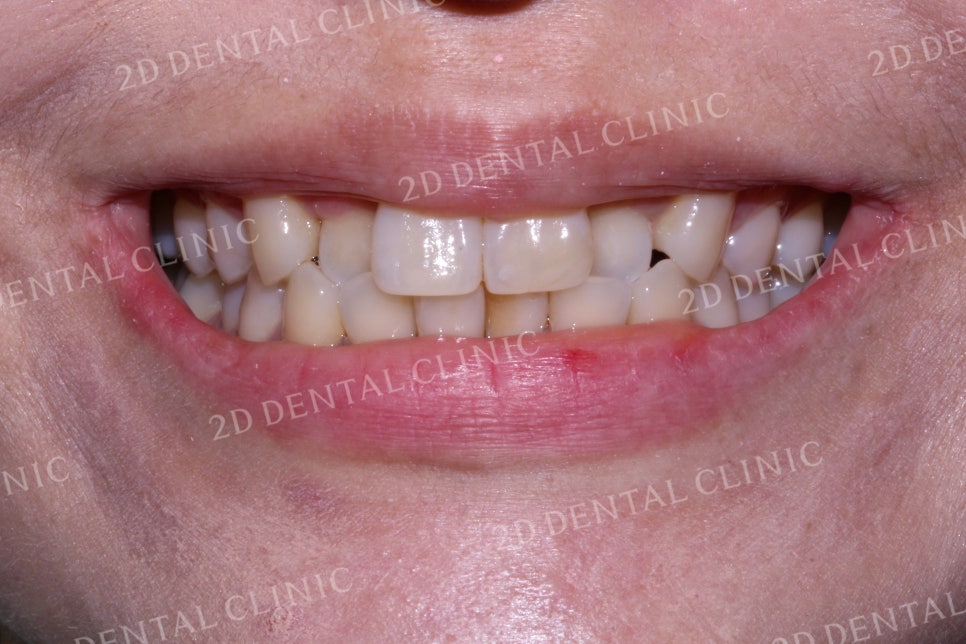 반대교합으로 물리는 치아를 바른 교합으로 교정하기! by.투디치과(2D치과) 관련 이미지 8