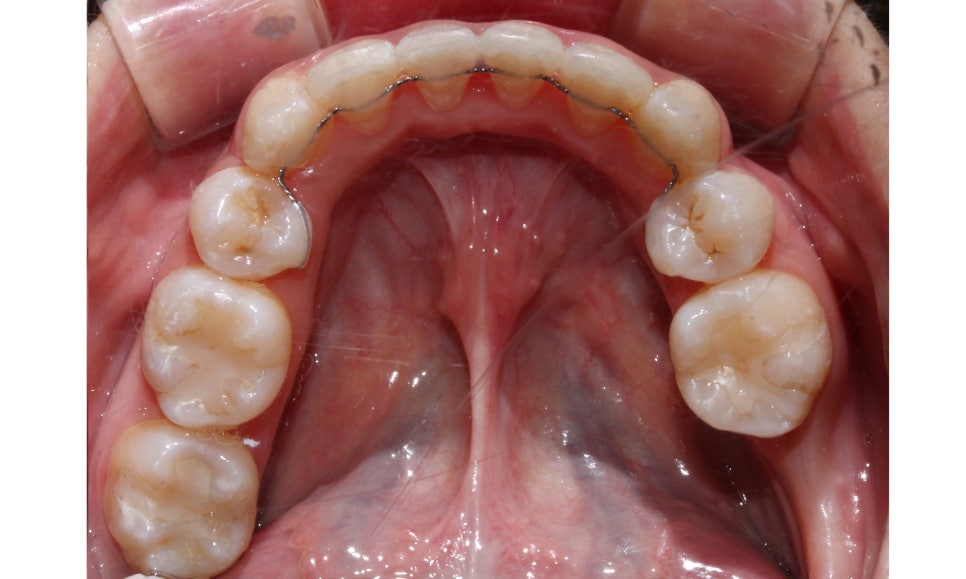 crowding 송곳니덧니 세라믹교정 방법 관련 이미지 14