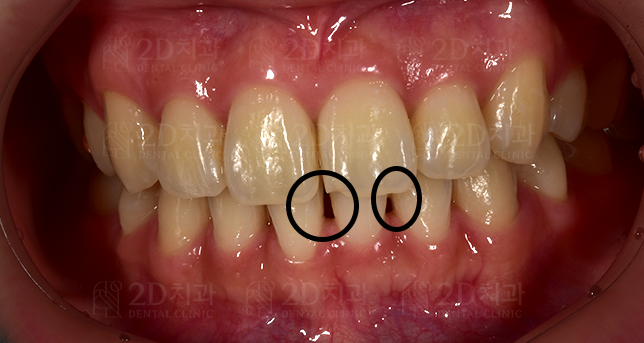 치아 블랙트라이앵글 원인, 예방, 치료 무삭제라미네이트 관련 이미지 2