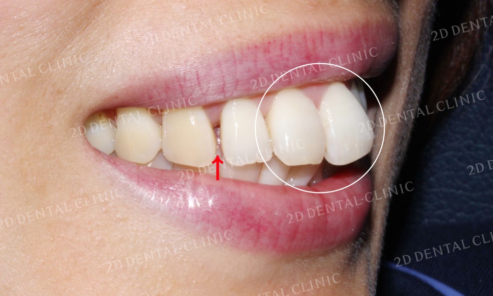 [앞니교정] 돌출앞니교정, 토끼앞니를 클리피씨교정으로 완성하기! by. 투디치과(2D치과) 관련 이미지 4