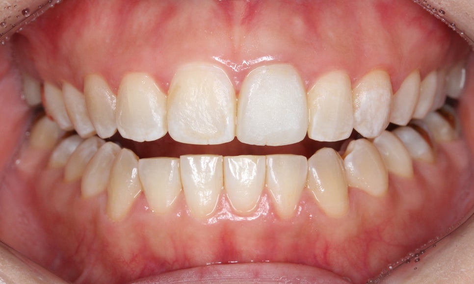 양악교정 송곳니교정 중심으로 관련 이미지 9