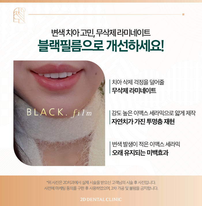 무삭제라미네이트비용 2D치과 변색치아를 하얗게! 관련 이미지 4