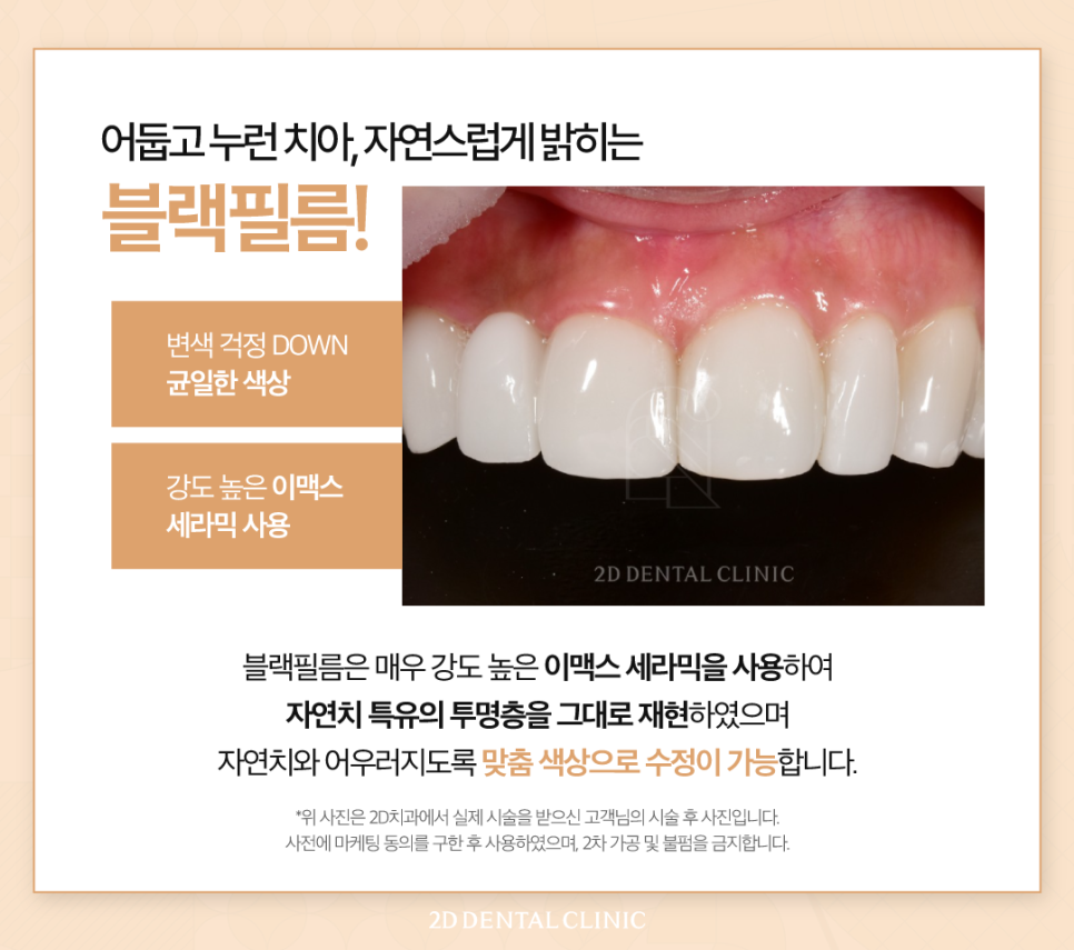 서초치과 치아변색치료 미백도 블랙필름으로 관련 이미지 4