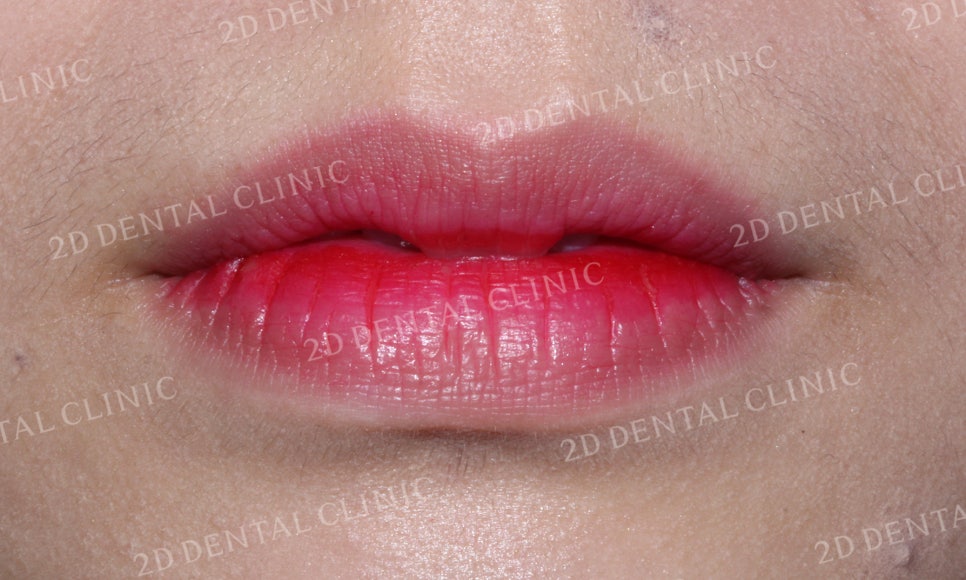 [앞니교정] 부정교합 교정, 앞니교정으로 부정교합 교정하는 방법! by. 투디치과(2D치과) 관련 이미지 8