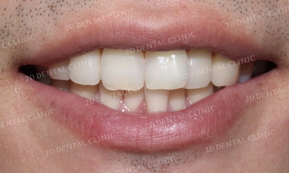 틀어진 앞니를 전체 교정으로 바르게! by.투디치과(2D치과) 관련 이미지 3