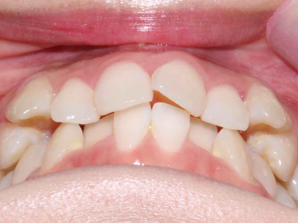 돌출입 탈출기! 덧니 교정도 문제없어! by.투디치과(2D치과) 관련 이미지 6