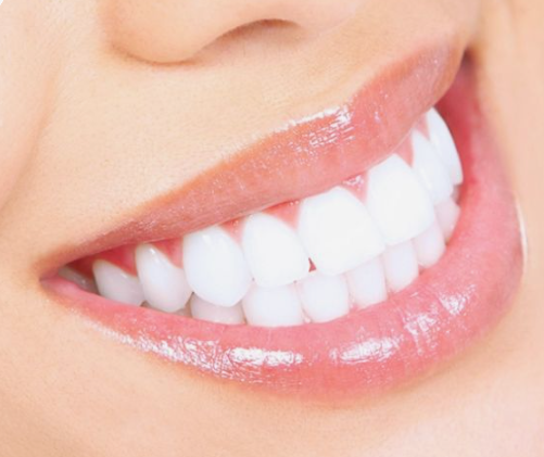 강남라미네이트병원 치아삭제 없는 무삭제치아성형 블랙필름 관련 이미지 2