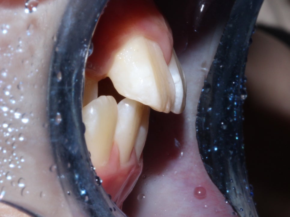 어린이 반대교합 덧니 교정으로 교정 끝! by. 투디치과(2D치과) 관련 이미지 10