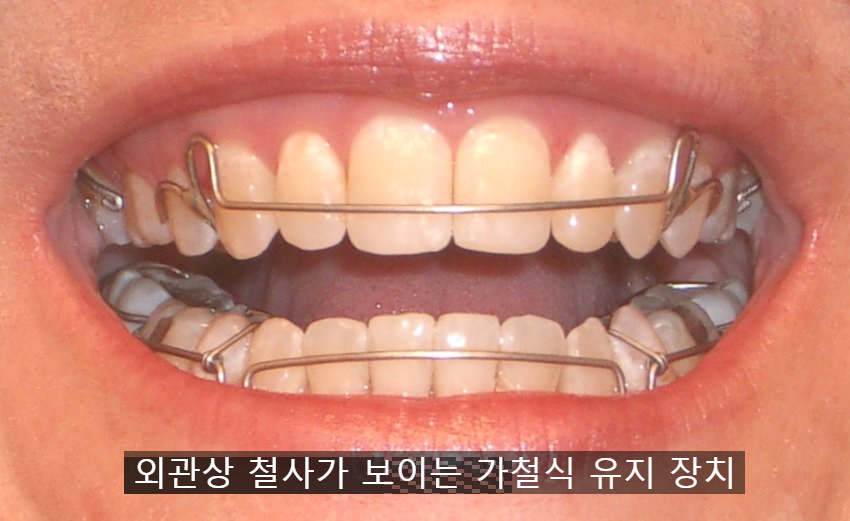 교정 유지 장치, 선택이 아닌 필수! 강남 2D치과 관련 이미지 9
