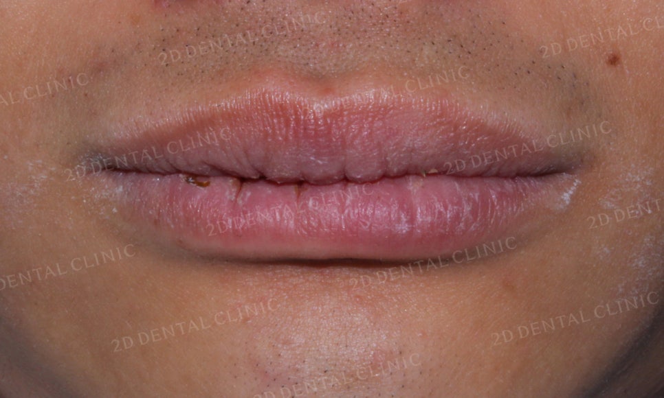 [앞니교정] 벌어진 앞니, 부분교정으로 앞니교정하기! by.2D치과(투디치과) 관련 이미지 8