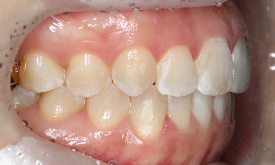 양악교정 송곳니교정 중심으로 관련 이미지 12