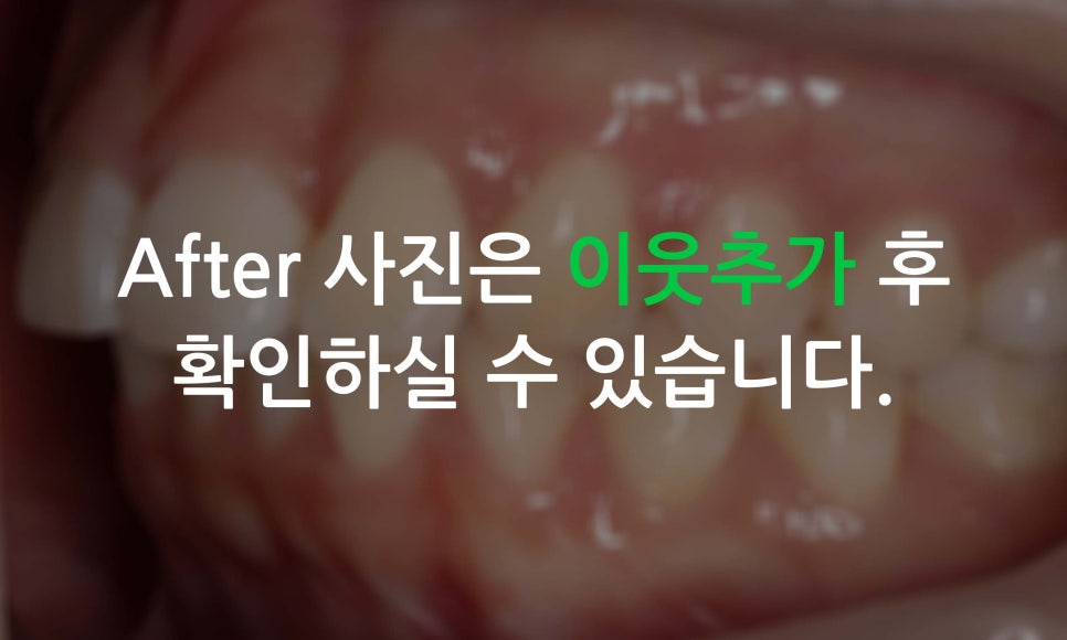 앞니틀어짐, 삐뚤어진 앞니를 부분교정하는 방법 관련 이미지 9