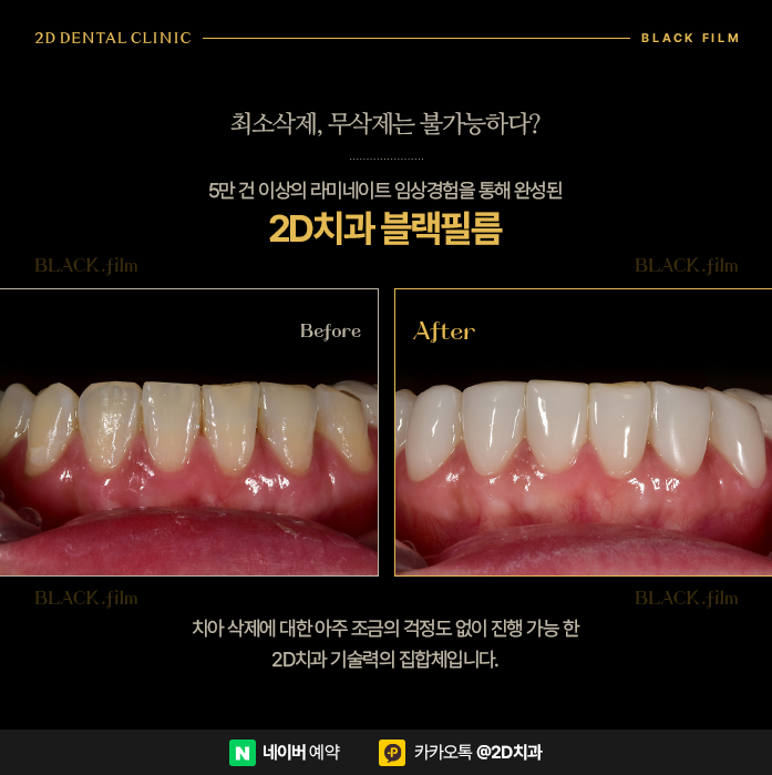 무삭제라미네이트비용 앞니라미네이트가격 알아보기 관련 이미지 11