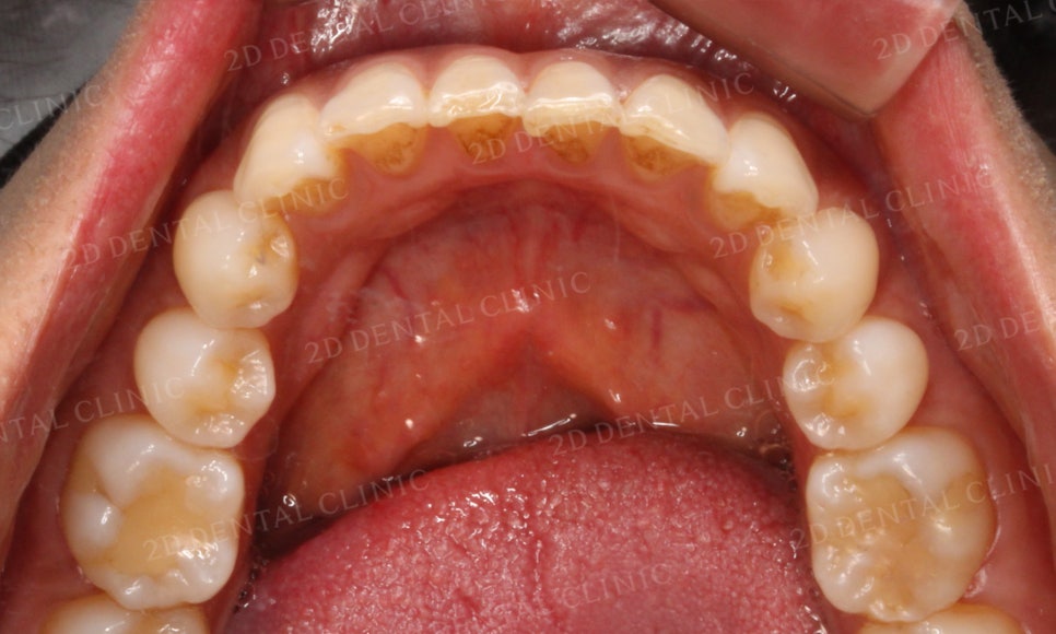 [부분교정] 틀어진 앞니, 부분교정으로 앞니교정하기! by.투디치과(2D치과) 관련 이미지 9