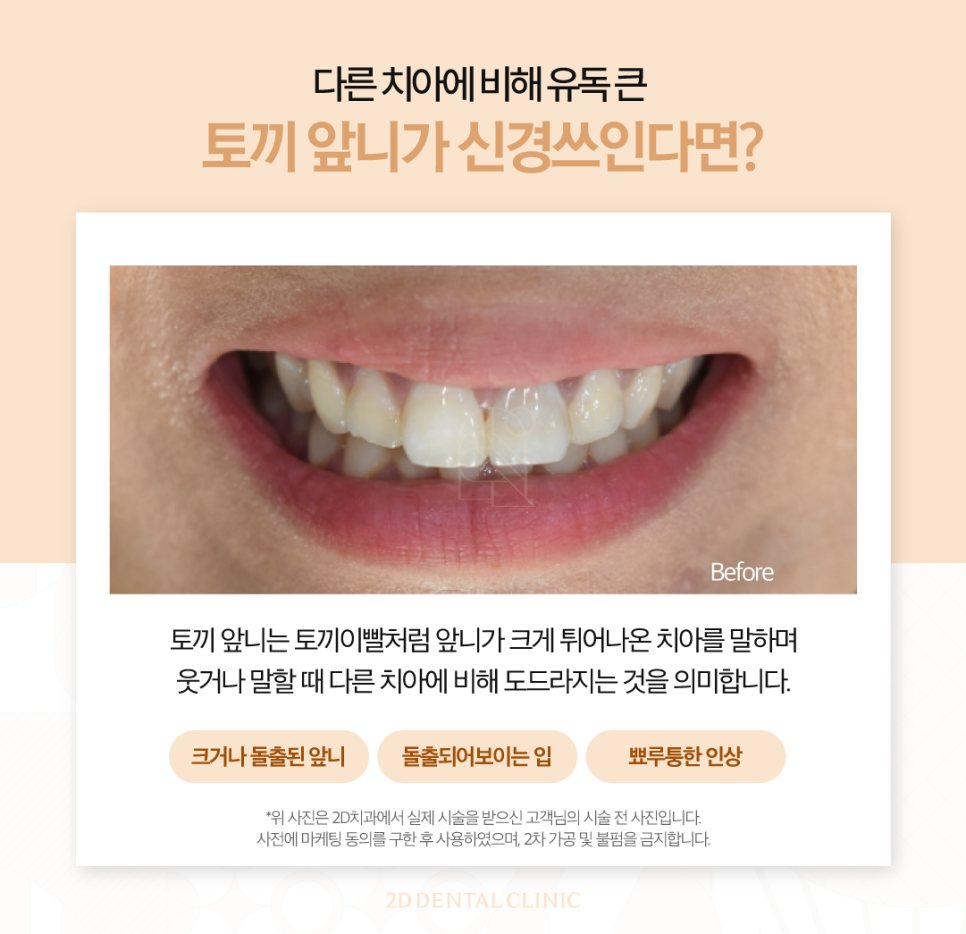 토끼이빨라미네이트 앞니성형으로 단정하고 우아하게 관련 이미지 3