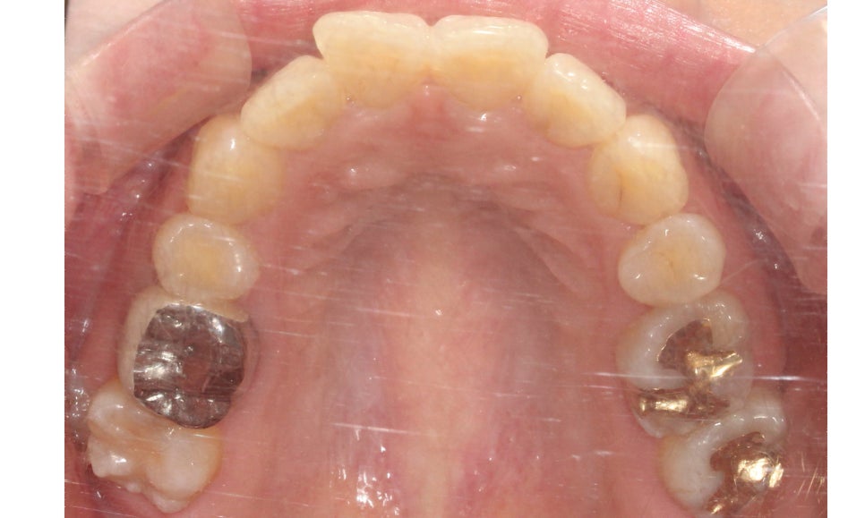 대치동치과 입툭튀 집어넣는 교정 관련 이미지 6