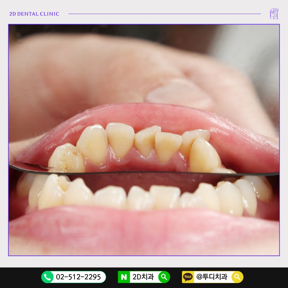 덧니만 부분교정으로 교정 할 수 있나요? 관련 이미지 6