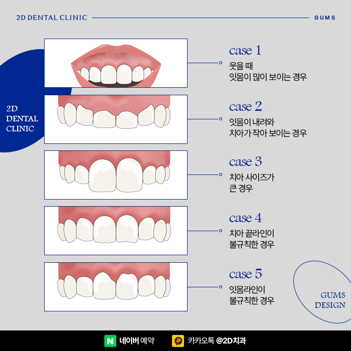 치아관리만큼 중요한 잇몸관리, 잇몸염증, 잇몸퇴축 예방하는 방법, 신논현 잇몸성형 관련 이미지 6