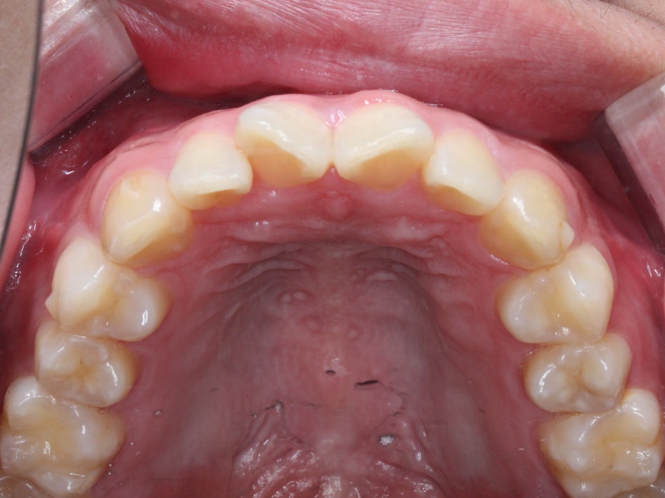 나비치아교정! 15개월만에 빠른 교정 by.투디치과(2D치과) 관련 이미지 7