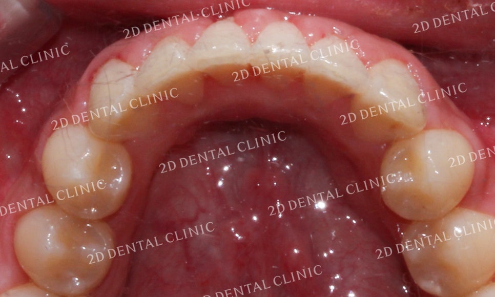 [투디교정] 덧니치아교정, 부분교정으로 쉽고 빠르게! by.투디치과(2D치과) 관련 이미지 16