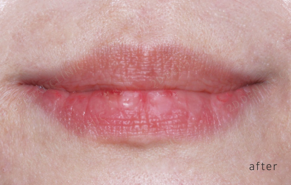 2D치과(투디치과) 교정일기ㅣ앞니덧니,반대교합 치아교정 완료!(ft.투디교정 전체교정) 관련 이미지 16