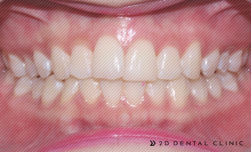 앞니 덧니 부분교정 케이스 전후비교, 교정전문 2D치과 관련 이미지 8