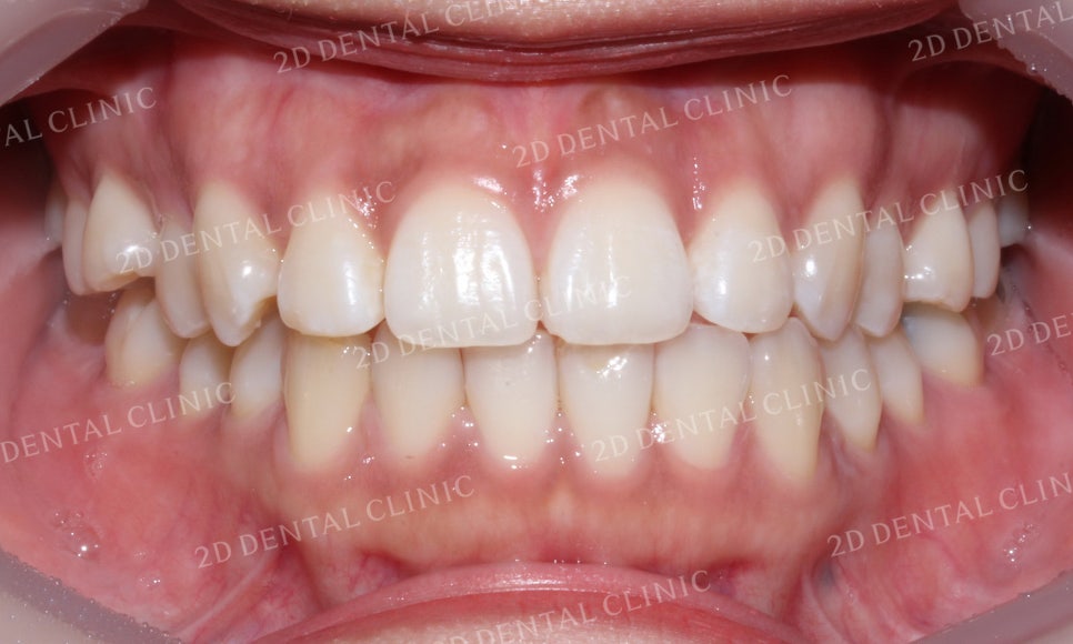 토끼앞니, 튀어나온 앞니 부분교정 후기! by.투디치과(2D치과) 관련 이미지 13