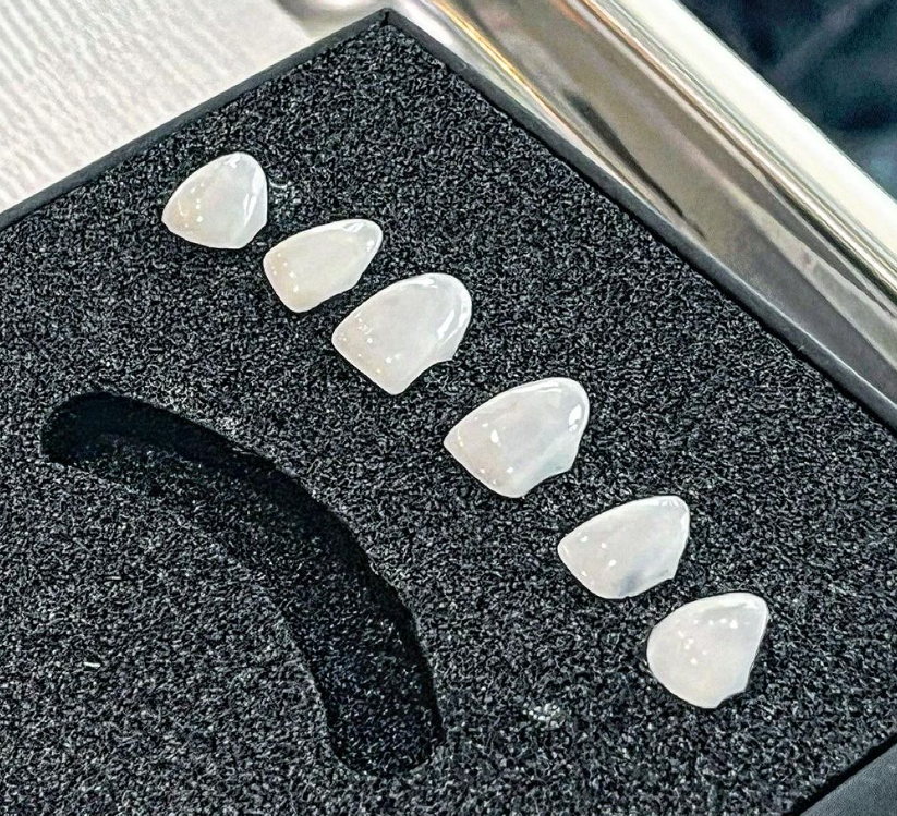 벌어진 치아 라미네이트 치아삭제 일절없는 블랙필름으로 개선가능합니다 관련 이미지 3