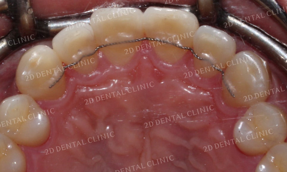 틀어진 앞니를 전체 교정으로 바르게! by.투디치과(2D치과) 관련 이미지 18