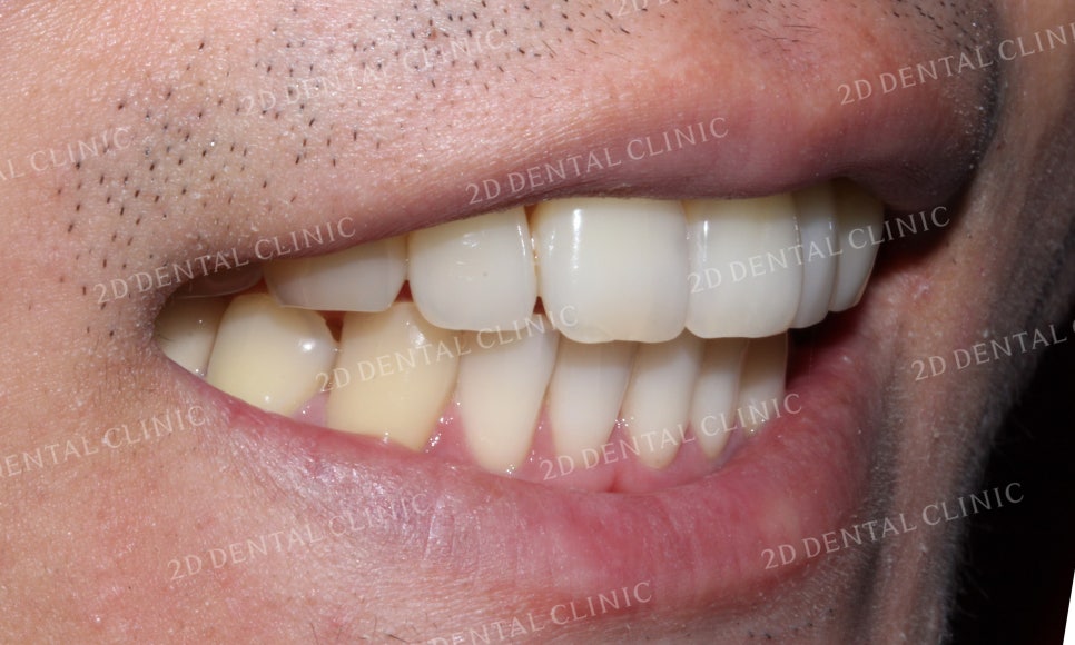 틀어진 앞니를 전체 교정으로 바르게! by.투디치과(2D치과) 관련 이미지 16
