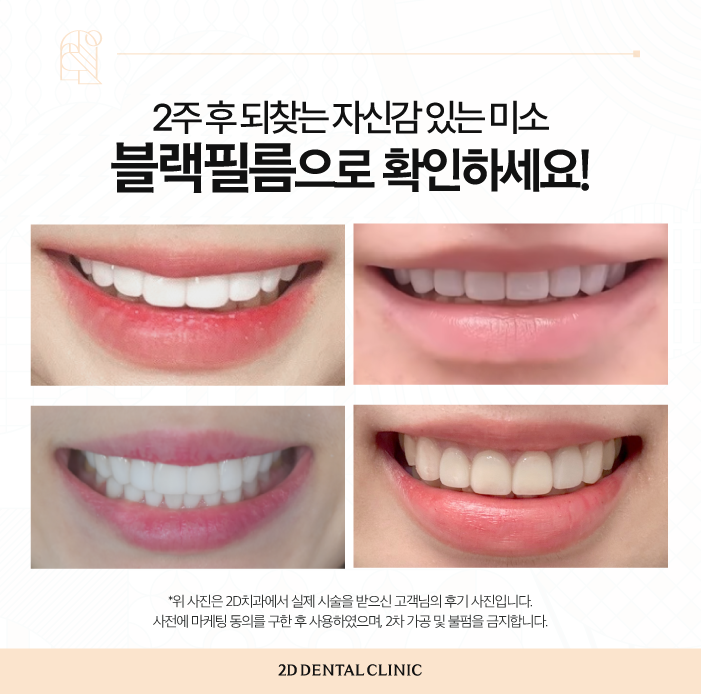 무삭제블랙필름 라미네이트치과 아름다운 미소를 위해 관련 이미지 6