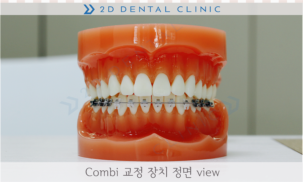 콤비교정, 합리적인 비용으로 돌출입 개선하자! 강남 투디치과 관련 이미지 4